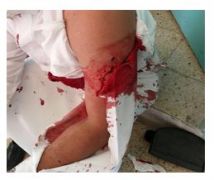 3 أشخاص يعتدون على معلم في الرياض بالطعن والضرب