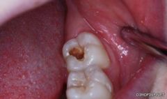 دراسة: ثقوب الأسنان تحمي من بعض أنواع السرطان