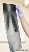 20 ثانية من الأشعة المقطعية تقلل معدل الوفيات بسرطان الرئة