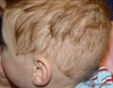 دراسة: علاج تساقط الشعر يشكل خطراً على الأطفال