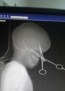 استخراج «مقص» اخترق جمجمة طفل في جدة