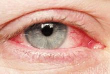 أسباب وعلاج إحمرار العين