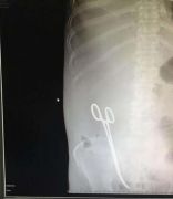 طبيب ينسى مقصا داخل بطن مريض بعد عملية جراحية في حائل